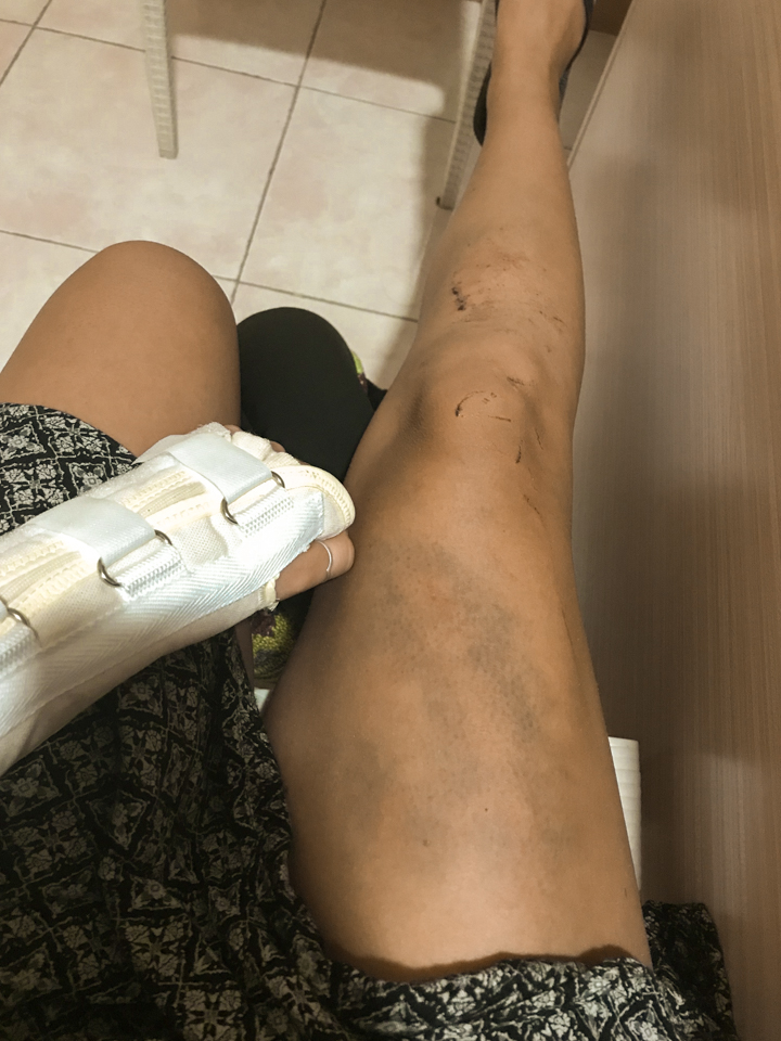 spellbound travels philippines injury